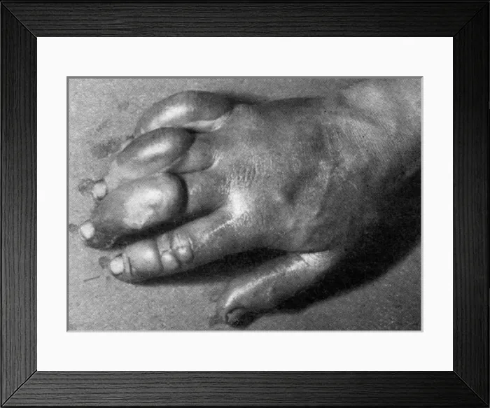 Framed Print : Frostbitten hand of Edward Atkinson, Antarctic expedition 19 Framed Print : Frostbitten hand of Edward Atkinson, Antarctic expedition 19