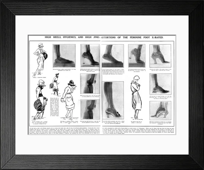 Framed Print : Foot x rays showing damage done by wearing high heels Framed Print : Foot x rays showing damage done by wearing high heels