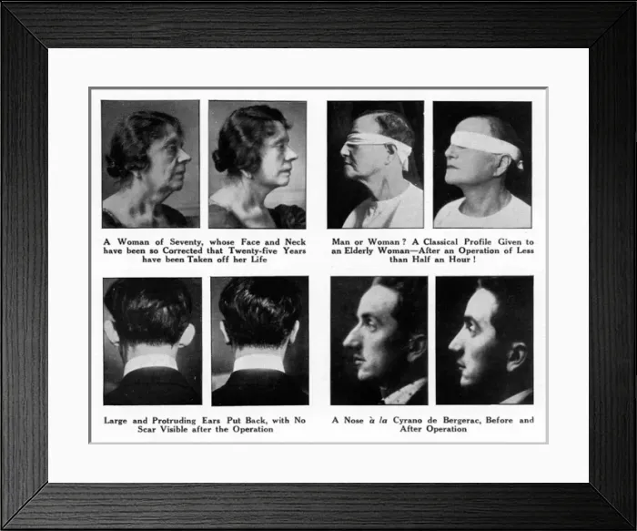 Framed Print : Plastic Surgery - Before and After Framed Print : Plastic Surgery - Before and After
