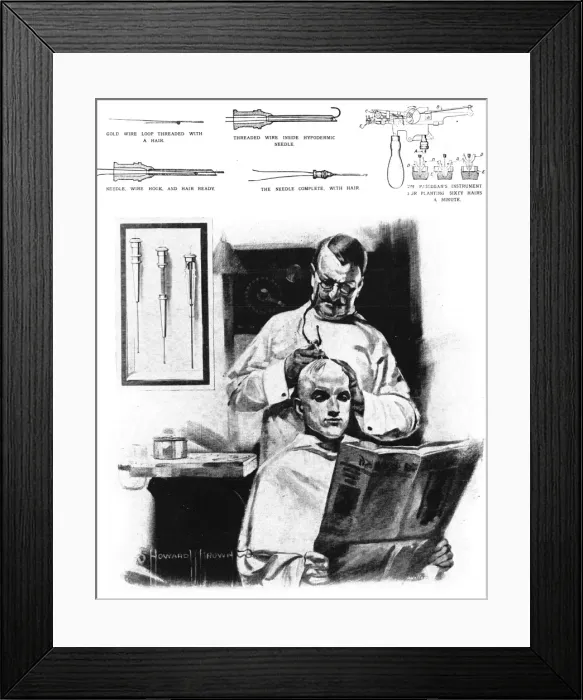 Framed Print : Hair transplant