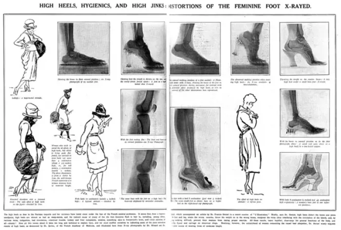 Framed Print : Foot x rays showing damage done by wearing high heels Framed Print : Foot x rays showing damage done by wearing high heels