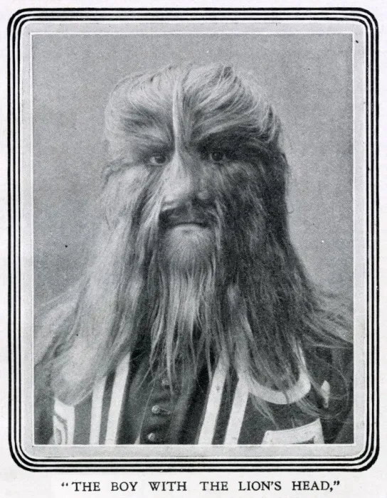 Framed Print : Stephan Bibrowski (1890 - 1932), know as Lionel the Lion-faced Man Framed Print : Stephan Bibrowski (1890 - 1932), know as Lionel the Lion-faced Man