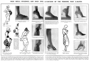 Bones Prints: Foot x rays showing damage done by wearing high heels