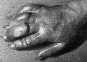 Surgeon Prints: Frostbitten hand of Edward Atkinson, Antarctic expedition 19