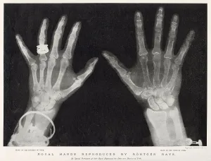 Early Prints: Royal Hands Reproduced by Rontgen Rays