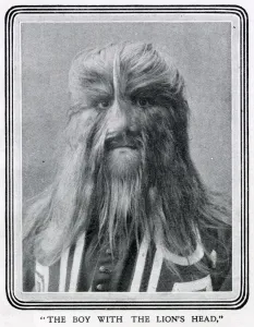 Hair Prints: Stephan Bibrowski (1890 - 1932), know as Lionel the Lion-faced Man